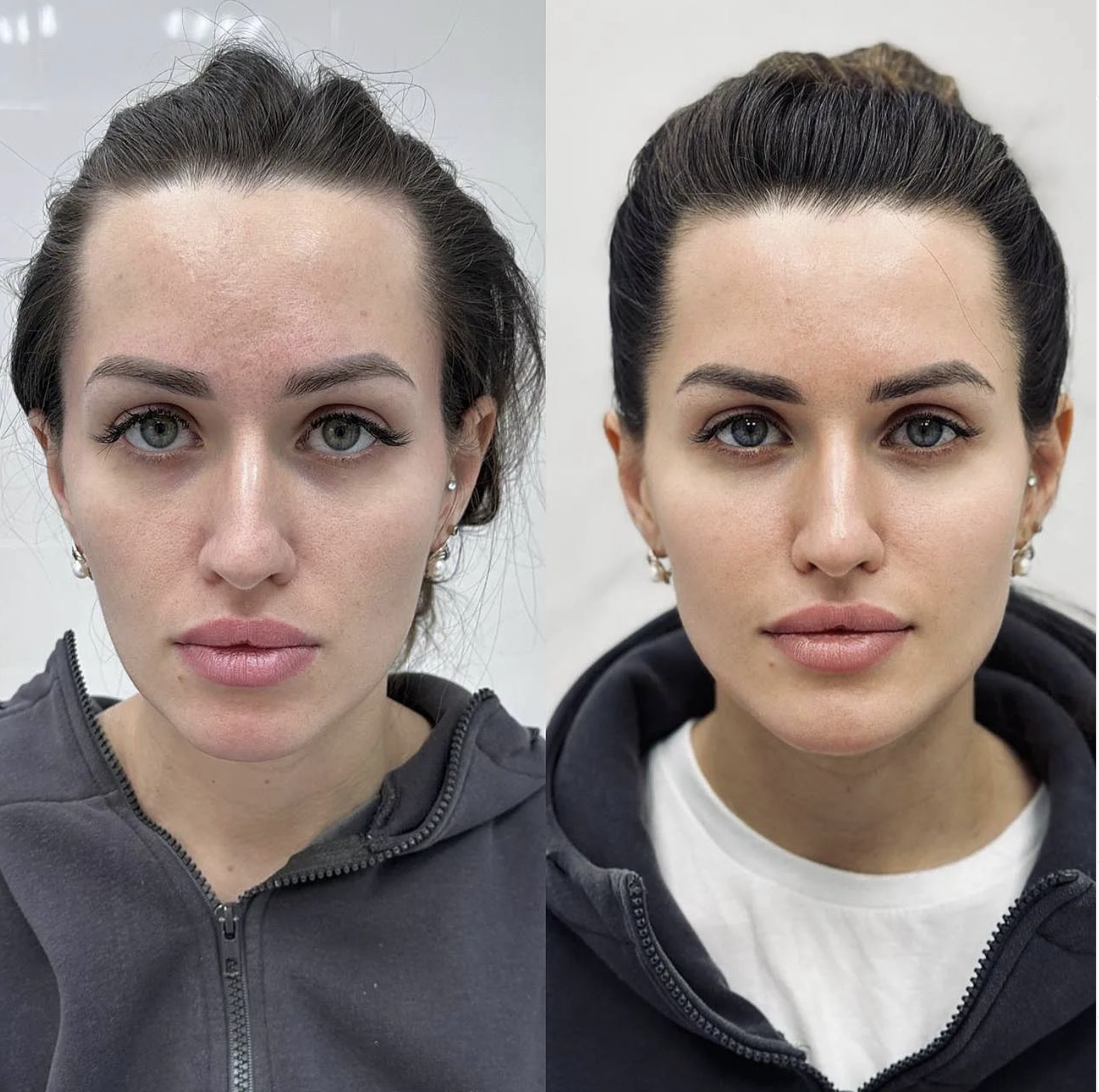 Face Rejuvenation