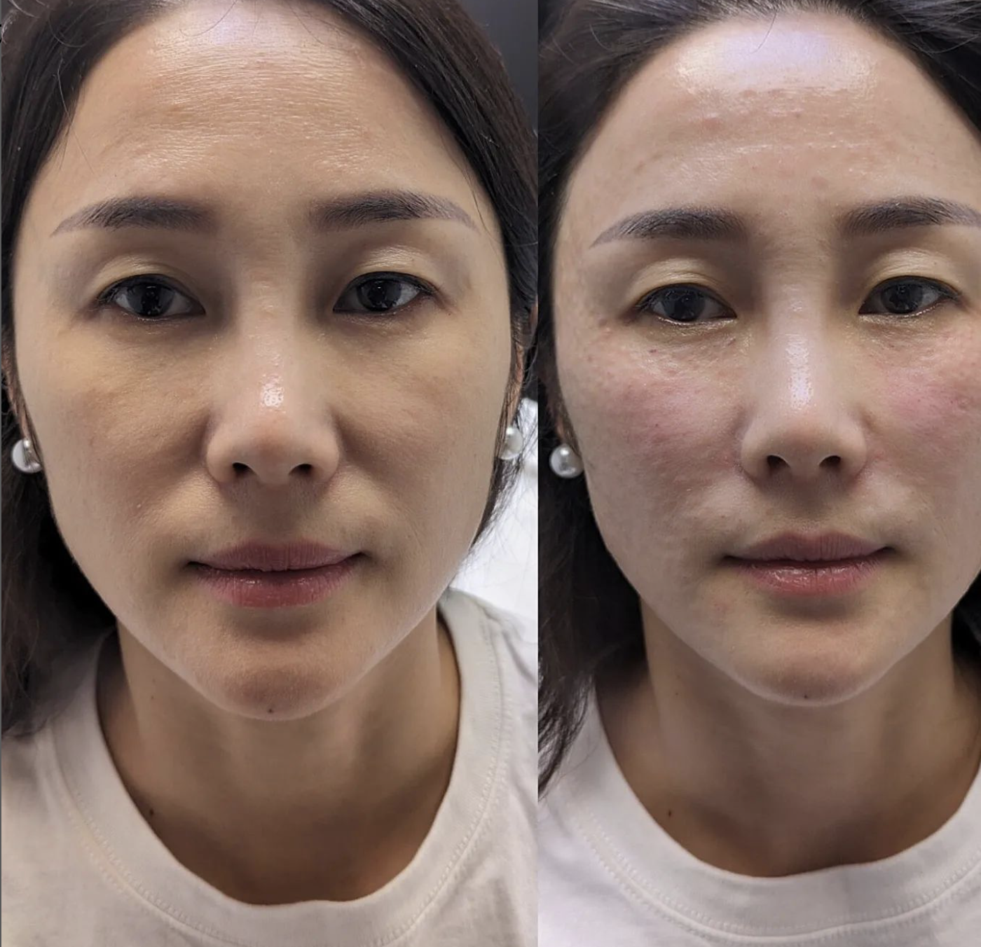 Mesotherapy
