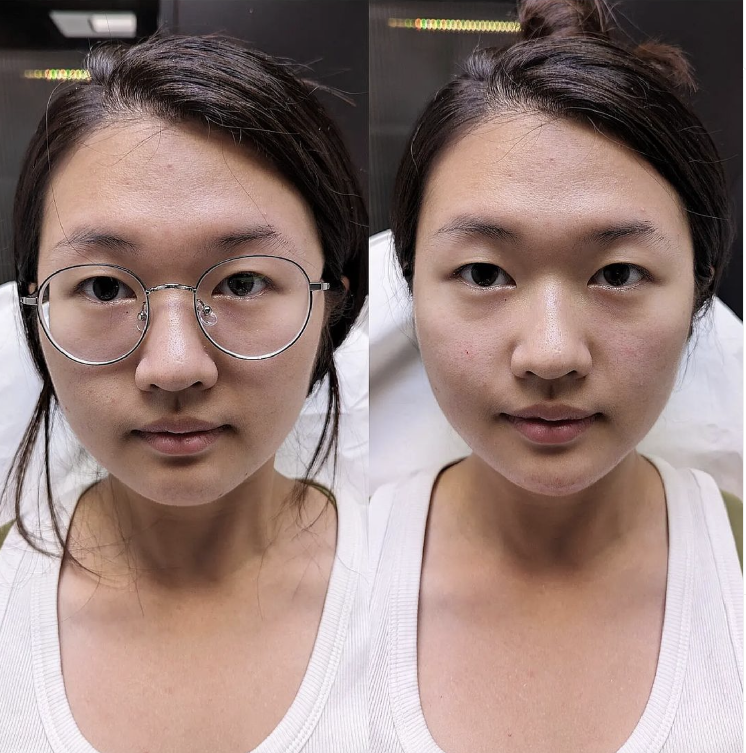 Nasolabial Folds