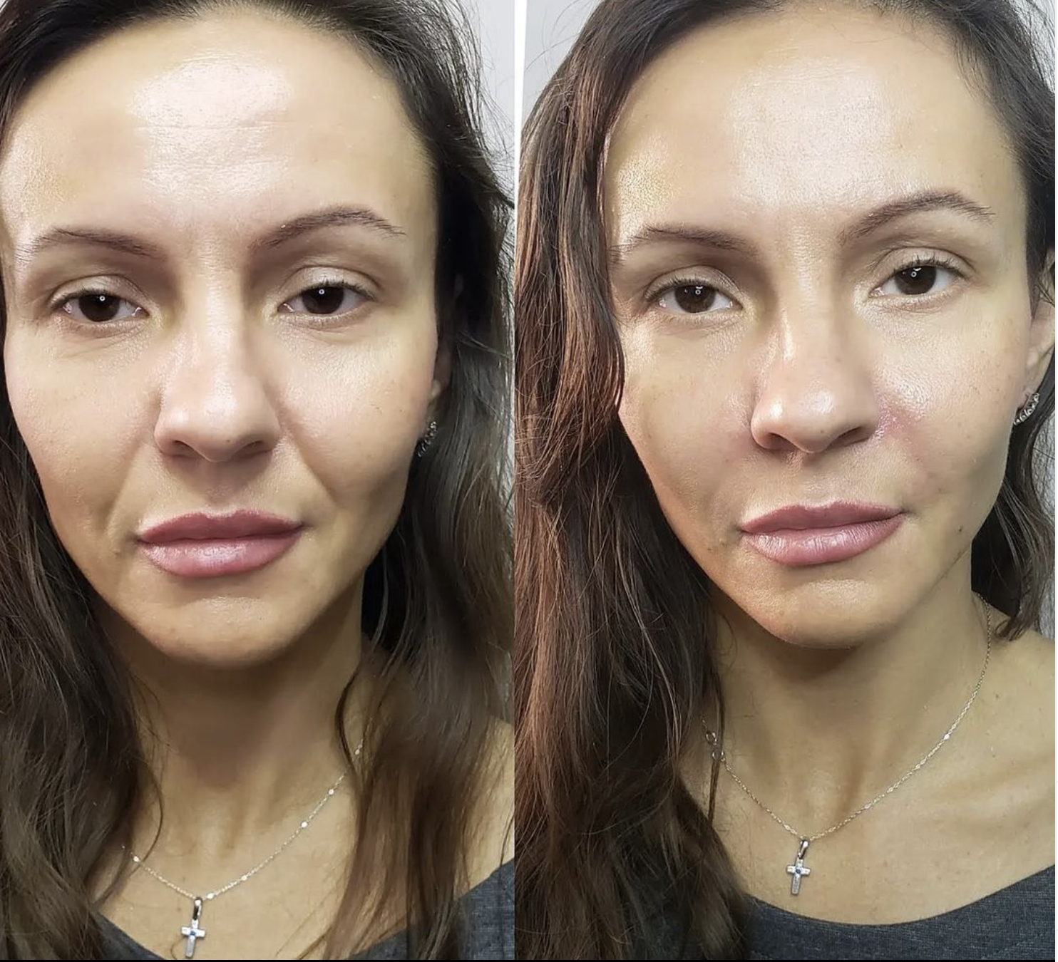 Dermal Fillers